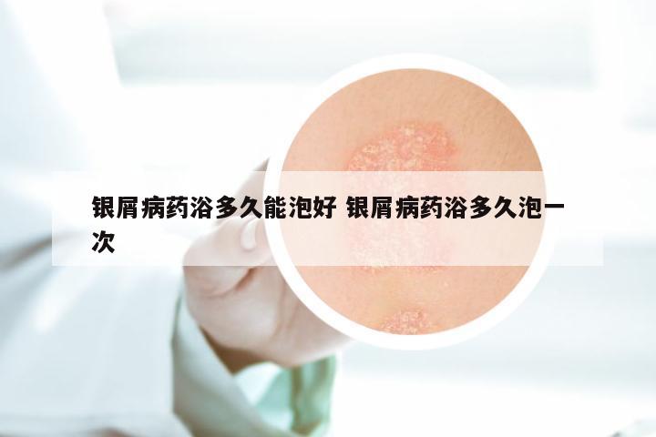 银屑病药浴多久能泡好 银屑病药浴多久泡一次