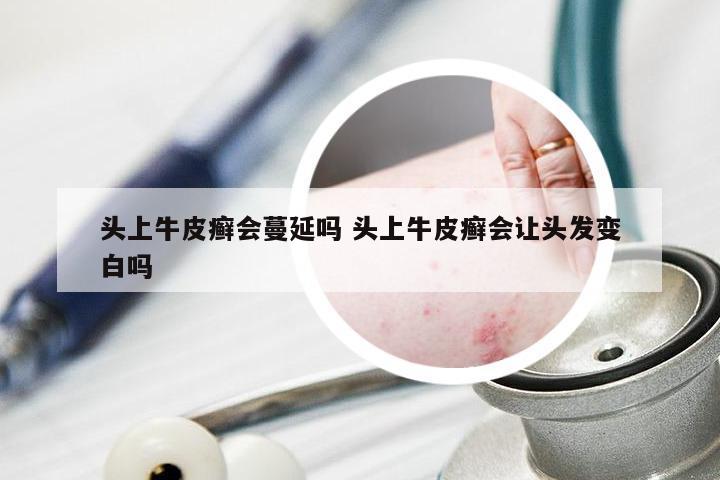 头上牛皮癣会蔓延吗 头上牛皮癣会让头发变白吗