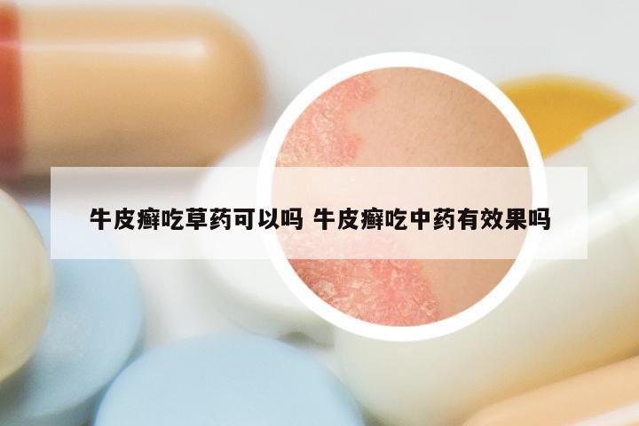 牛皮癣吃草药可以吗 牛皮癣吃中药有效果吗