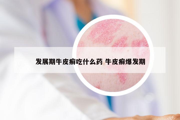 发展期牛皮癣吃什么药 牛皮癣爆发期