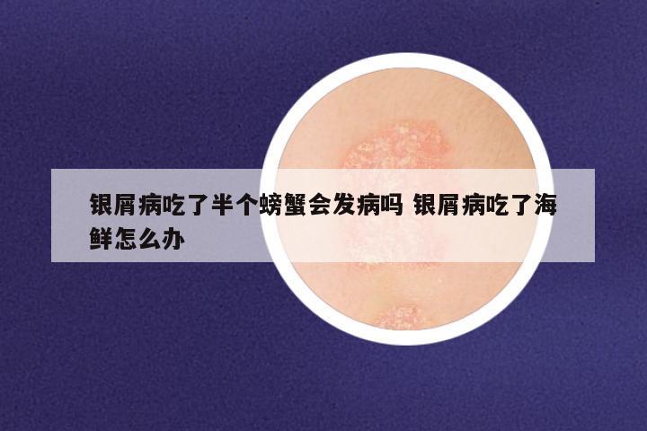 银屑病吃了半个螃蟹会发病吗 银屑病吃了海鲜怎么办