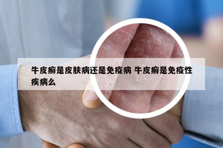 牛皮癣是皮肤病还是免疫病 牛皮癣是免疫性疾病么