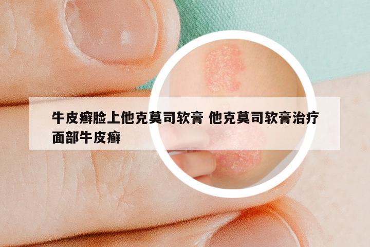 牛皮癣脸上他克莫司软膏 他克莫司软膏治疗面部牛皮癣