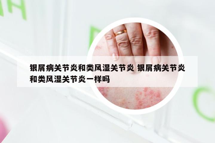 银屑病关节炎和类风湿关节炎 银屑病关节炎和类风湿关节炎一样吗