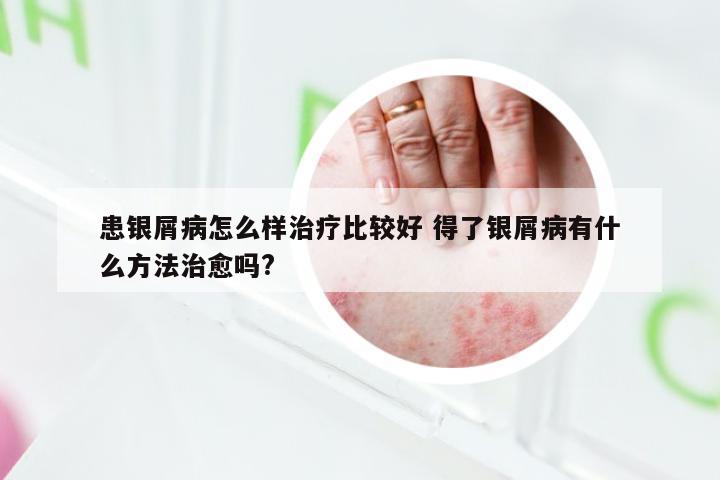 患银屑病怎么样治疗比较好 得了银屑病有什么方法治愈吗?