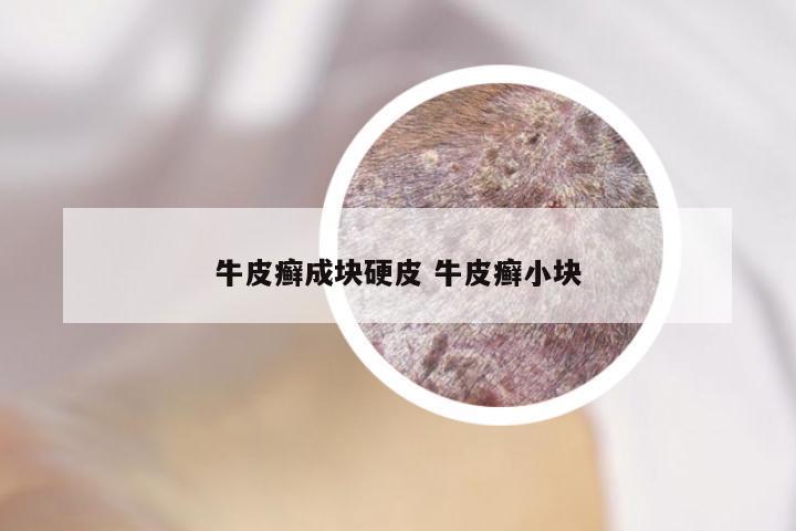 牛皮癣成块硬皮 牛皮癣小块