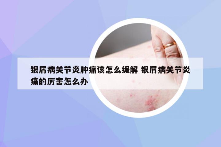 银屑病关节炎肿痛该怎么缓解 银屑病关节炎痛的厉害怎么办