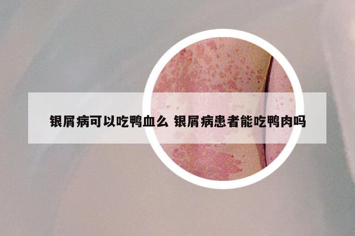 银屑病可以吃鸭血么 银屑病患者能吃鸭肉吗