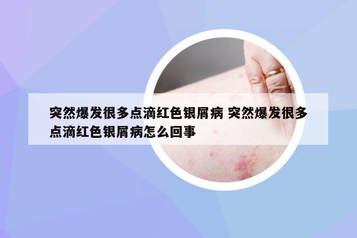 突然爆发很多点滴红色银屑病 突然爆发很多点滴红色银屑病怎么回事
