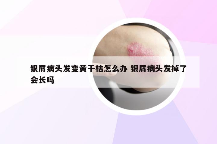 银屑病头发变黄干枯怎么办 银屑病头发掉了会长吗