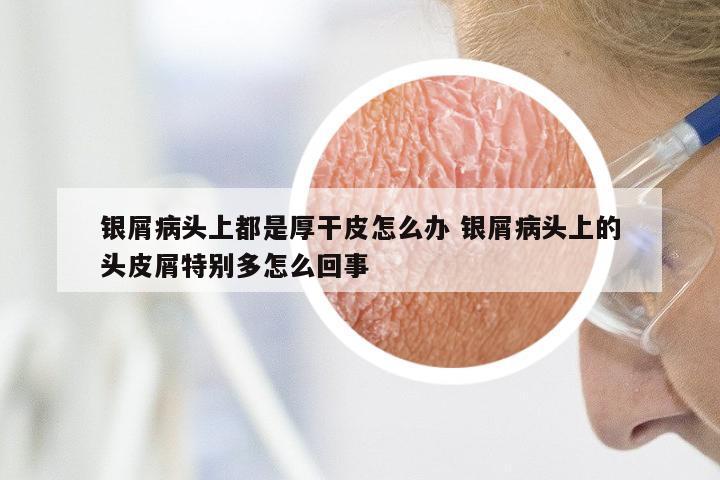 银屑病头上都是厚干皮怎么办 银屑病头上的头皮屑特别多怎么回事