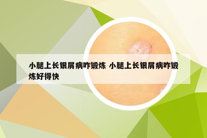 小腿上长银屑病咋锻炼 小腿上长银屑病咋锻炼好得快