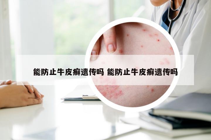 能防止牛皮癣遗传吗 能防止牛皮癣遗传吗