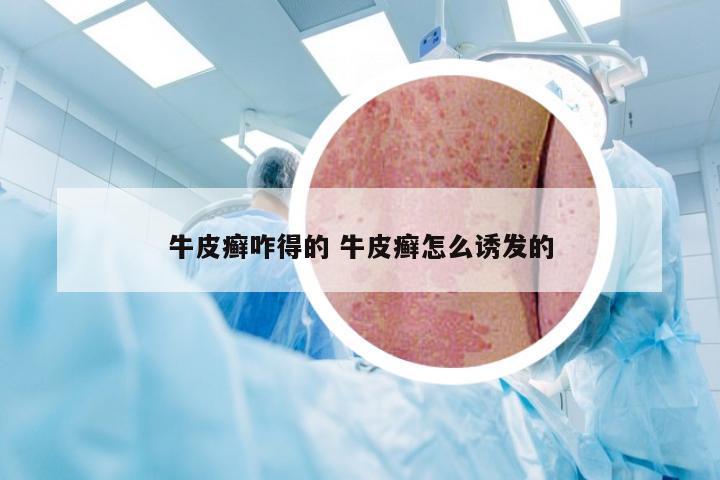 牛皮癣咋得的 牛皮癣怎么诱发的