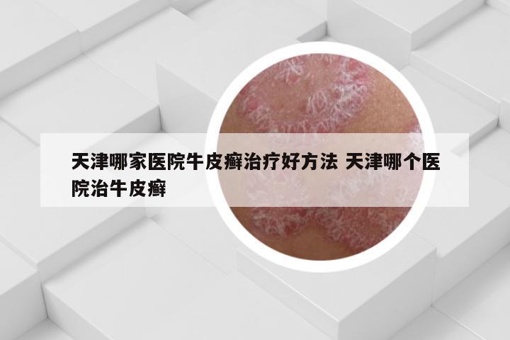 天津哪家医院牛皮癣治疗好方法 天津哪个医院治牛皮癣