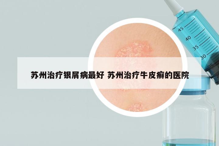 苏州治疗银屑病最好 苏州治疗牛皮癣的医院