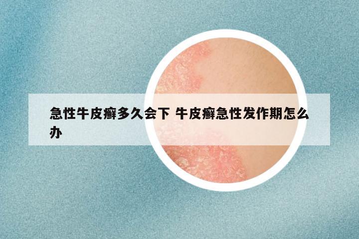 急性牛皮癣多久会下 牛皮癣急性发作期怎么办