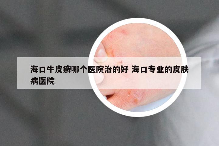 海口牛皮癣哪个医院治的好 海口专业的皮肤病医院