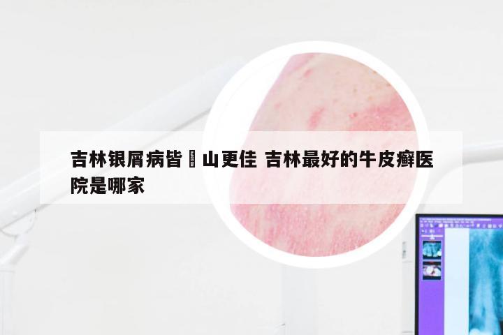 吉林银屑病皆崋山更佳 吉林最好的牛皮癣医院是哪家