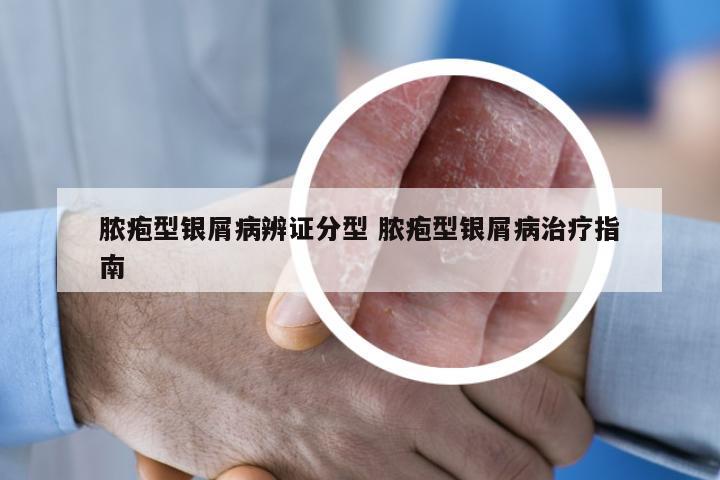 脓疱型银屑病辨证分型 脓疱型银屑病治疗指南