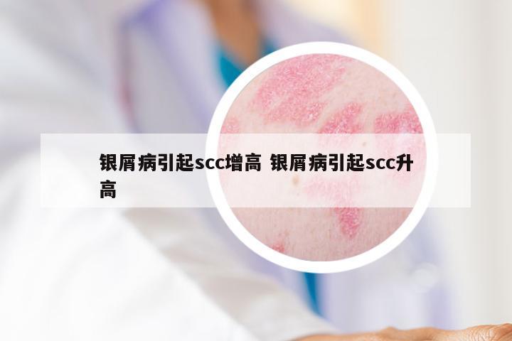 银屑病引起scc增高 银屑病引起scc升高
