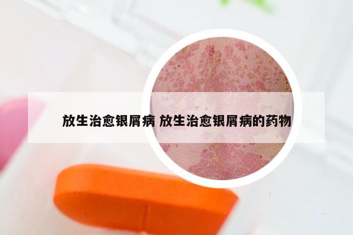 放生治愈银屑病 放生治愈银屑病的药物