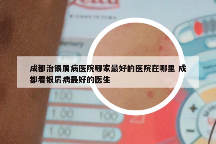 成都治银屑病医院哪家最好的医院在哪里 成都看银屑病最好的医生