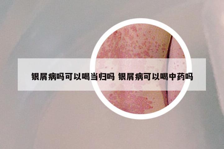 银屑病吗可以喝当归吗 银屑病可以喝中药吗
