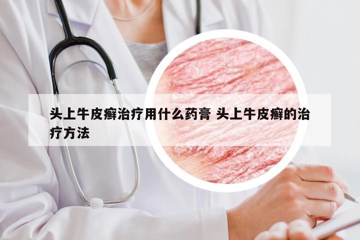 头上牛皮癣治疗用什么药膏 头上牛皮癣的治疗方法