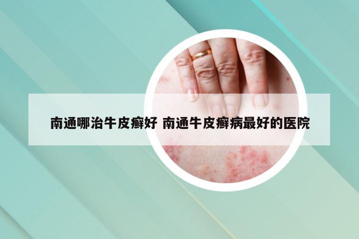 南通哪治牛皮癣好 南通牛皮癣病最好的医院