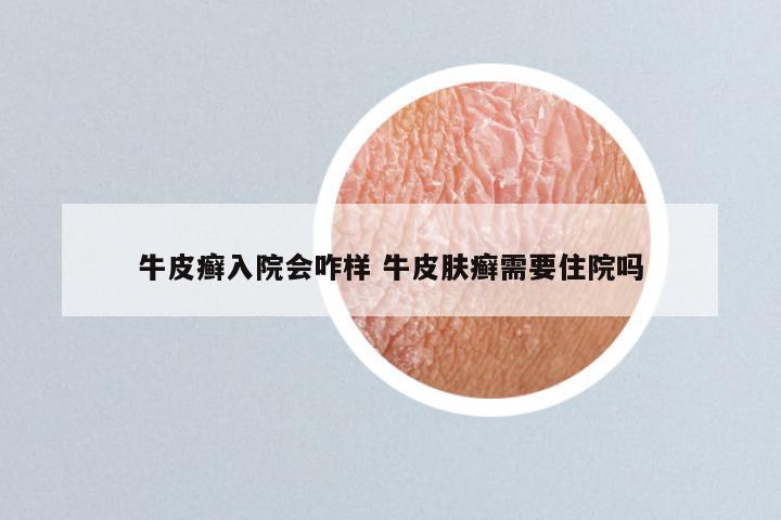 牛皮癣入院会咋样 牛皮肤癣需要住院吗