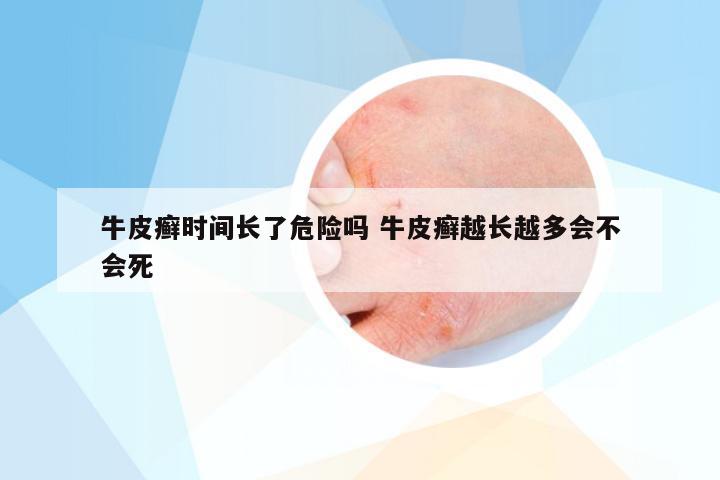 牛皮癣时间长了危险吗 牛皮癣越长越多会不会死