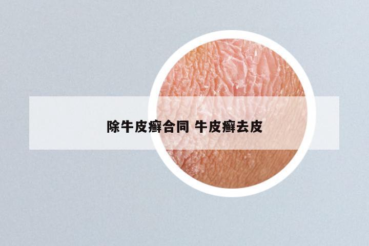 除牛皮癣合同 牛皮癣去皮