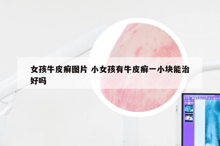 女孩牛皮癣图片 小女孩有牛皮癣一小块能治好吗