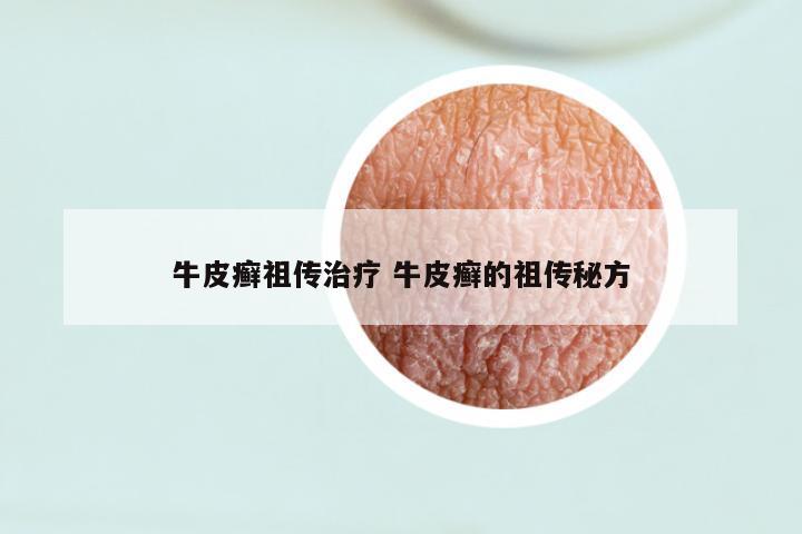 牛皮癣祖传治疗 牛皮癣的祖传秘方
