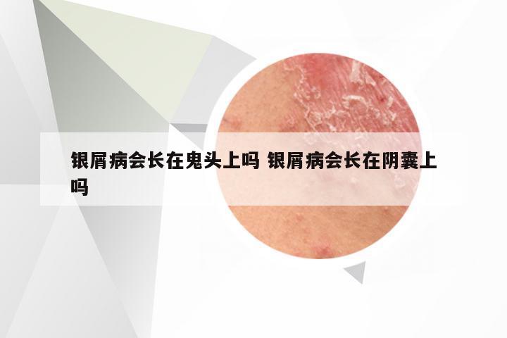 银屑病会长在鬼头上吗 银屑病会长在阴囊上吗