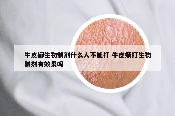 牛皮癣生物制剂什么人不能打 牛皮癣打生物制剂有效果吗