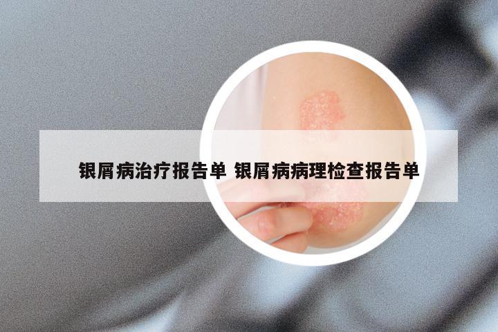 银屑病治疗报告单 银屑病病理检查报告单