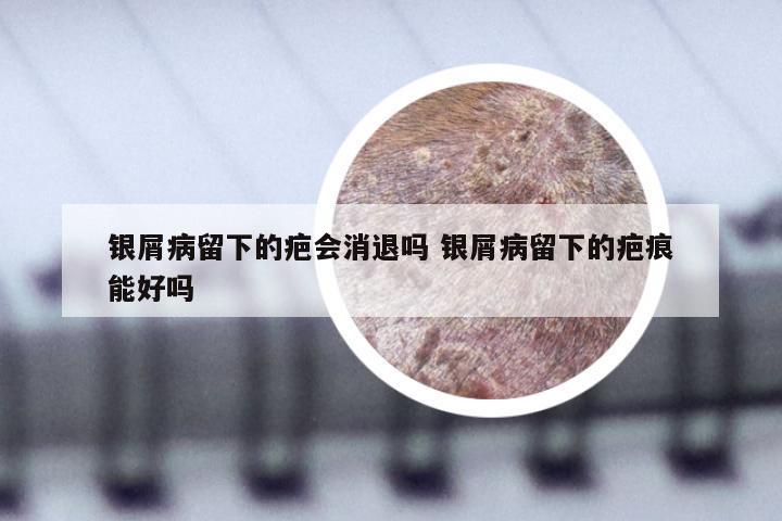 银屑病留下的疤会消退吗 银屑病留下的疤痕能好吗