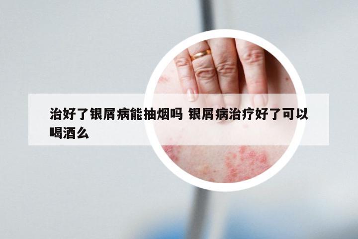 治好了银屑病能抽烟吗 银屑病治疗好了可以喝酒么