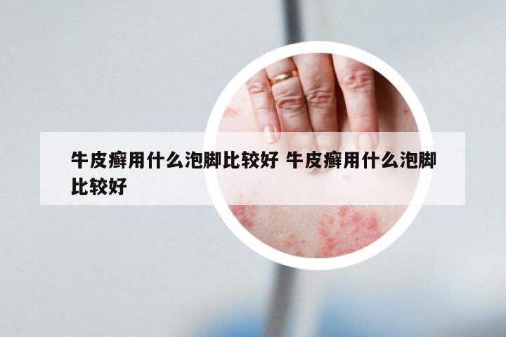 牛皮癣用什么泡脚比较好 牛皮癣用什么泡脚比较好