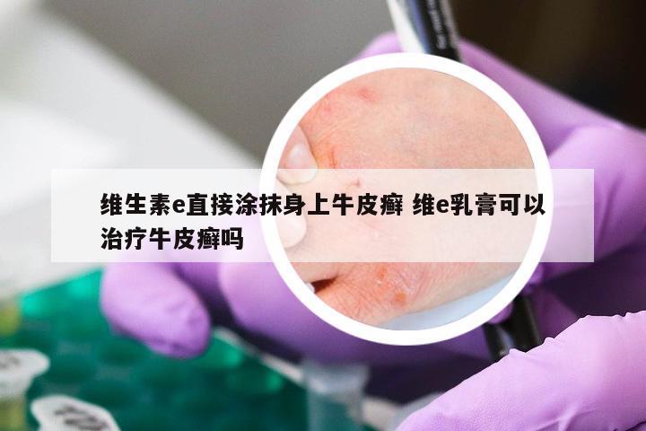维生素e直接涂抹身上牛皮癣 维e乳膏可以治疗牛皮癣吗