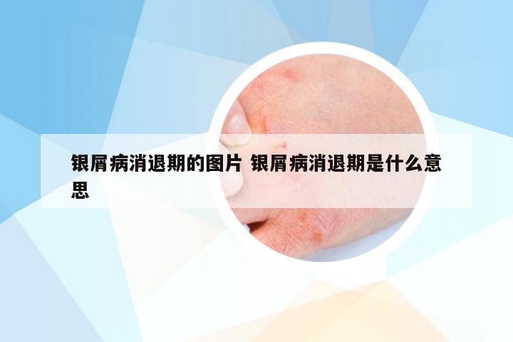 银屑病消退期的图片 银屑病消退期是什么意思