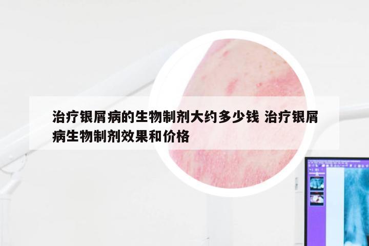 治疗银屑病的生物制剂大约多少钱 治疗银屑病生物制剂效果和价格