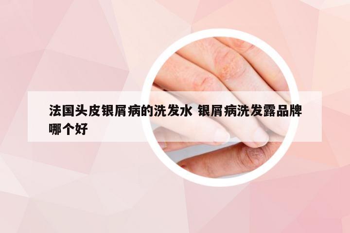 法国头皮银屑病的洗发水 银屑病洗发露品牌哪个好
