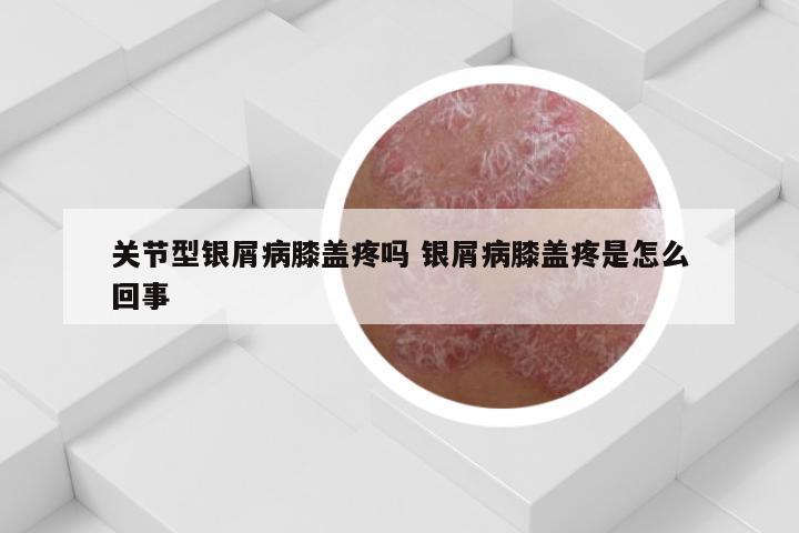 关节型银屑病膝盖疼吗 银屑病膝盖疼是怎么回事