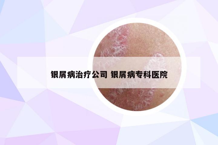 银屑病治疗公司 银屑病专科医院