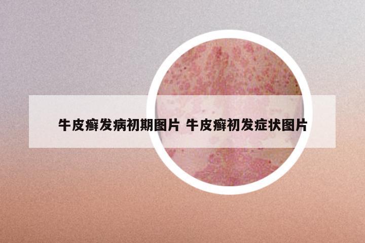 牛皮癣发病初期图片 牛皮癣初发症状图片