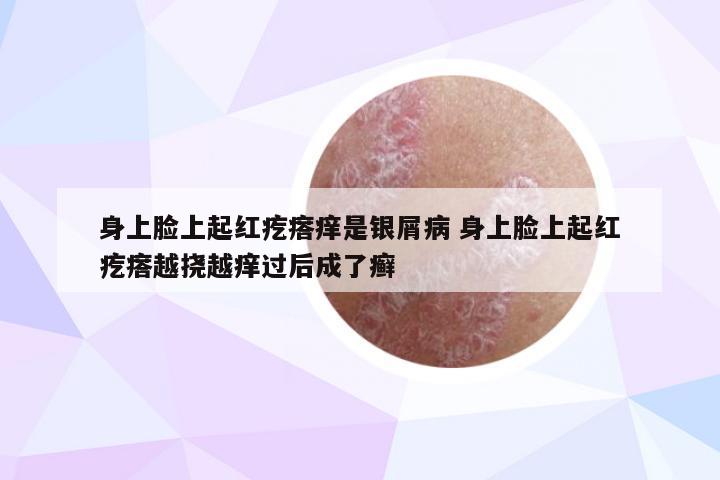 身上脸上起红疙瘩痒是银屑病 身上脸上起红疙瘩越挠越痒过后成了癣