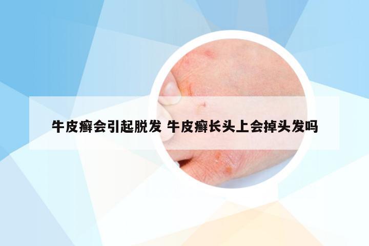 牛皮癣会引起脱发 牛皮癣长头上会掉头发吗